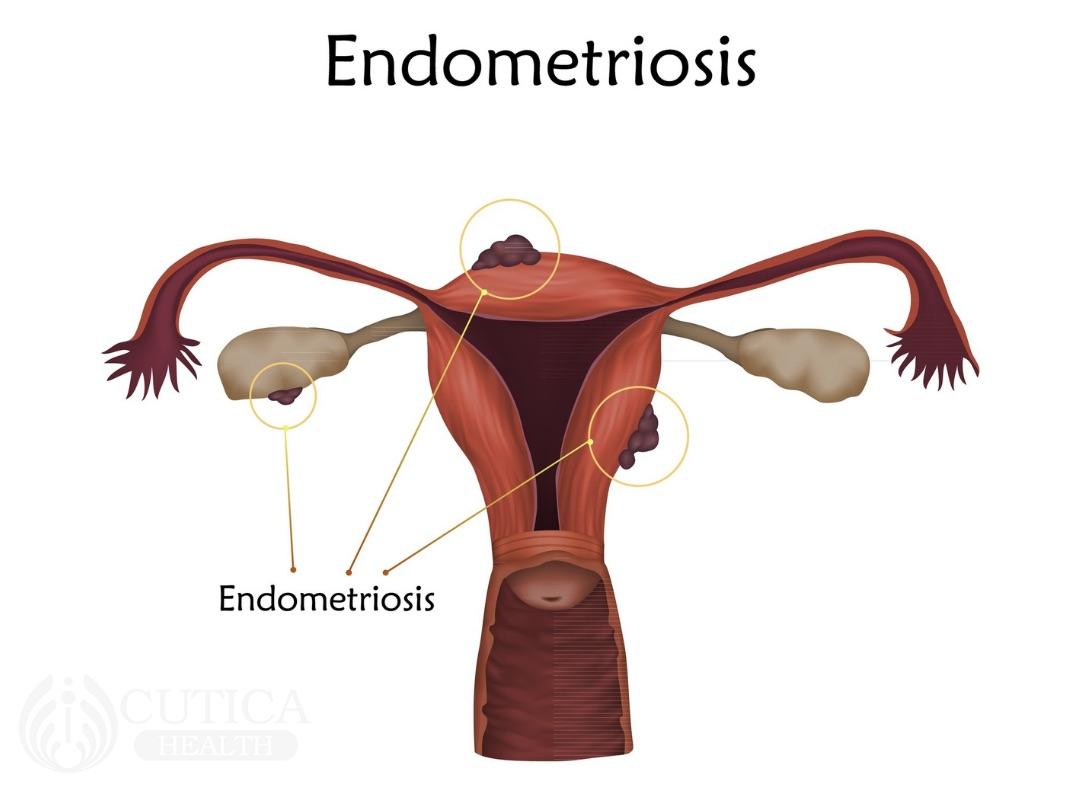 Period Pain: Could It Be Endometriosis?