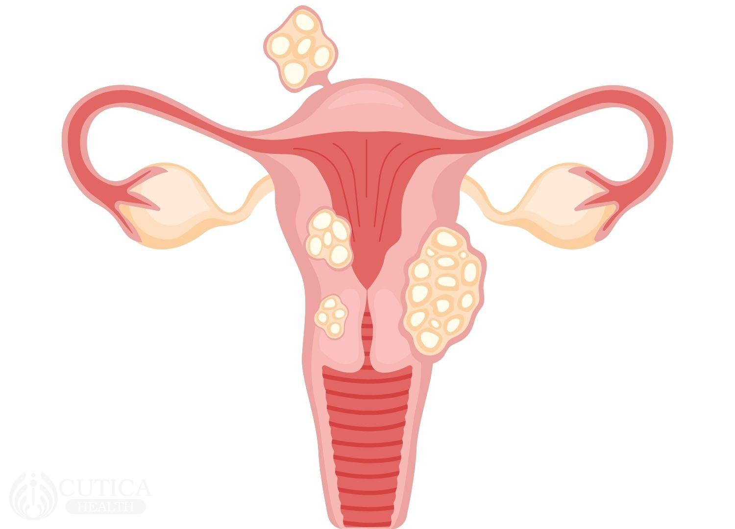 How Do Fibroids Affect Pregnancy and Fertility? - Bastion HMO